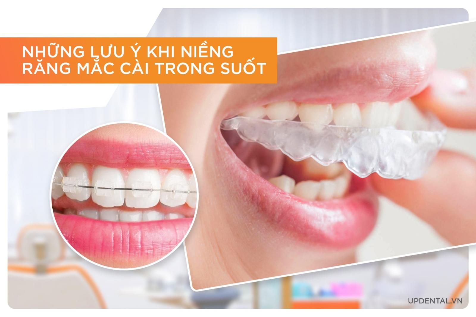 Lưu ý khi niềng răng mắc cài trong suốt