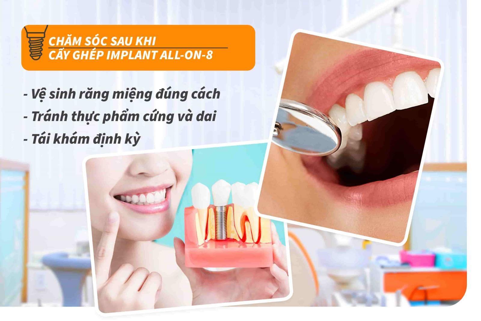 Những lưu ý sau khi cấy ghép Implant All-on-8 