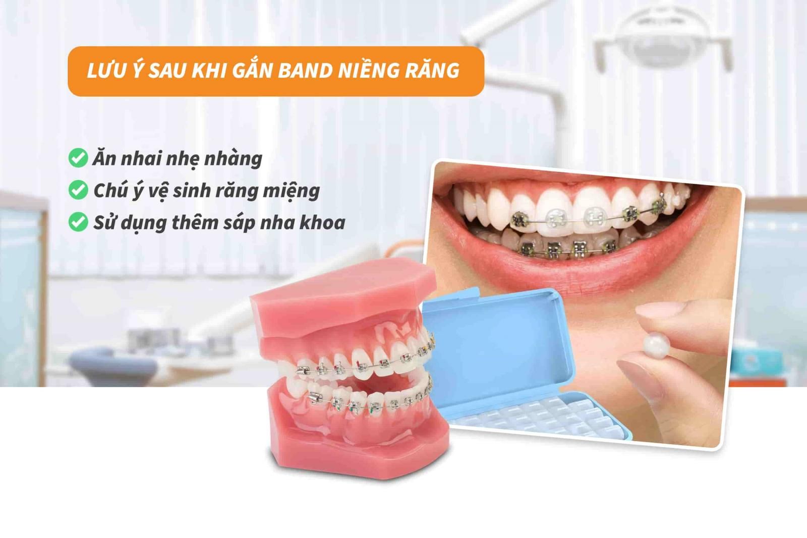 Lưu ý sau khi gắn band niềng răng 