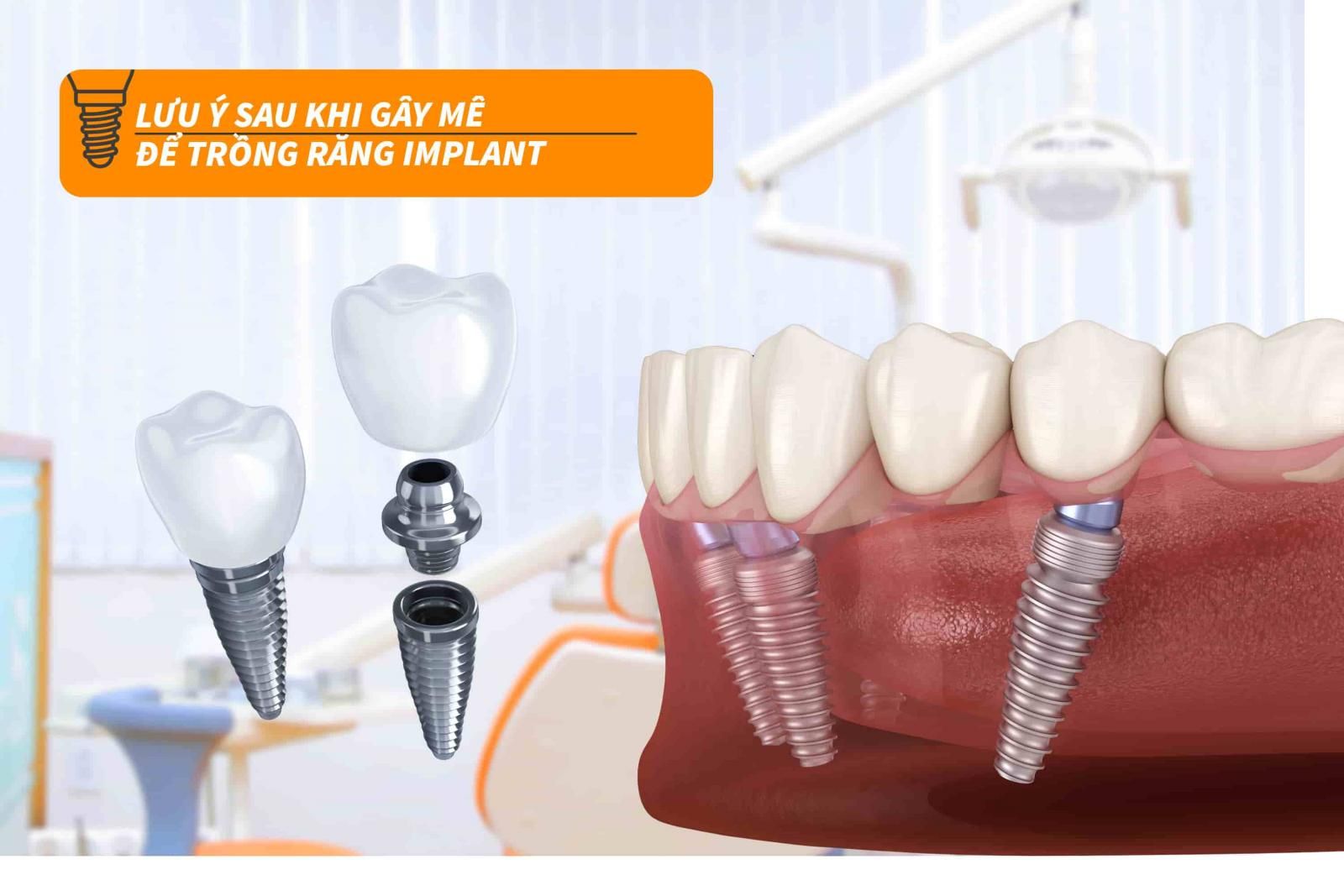 Lưu ý sau khi gây mê để trồng răng Implant