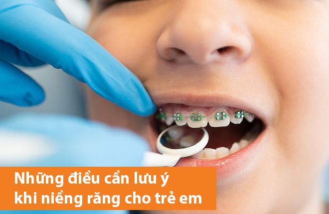 Những điều cần lưu ý khi niềng răng cho trẻ em