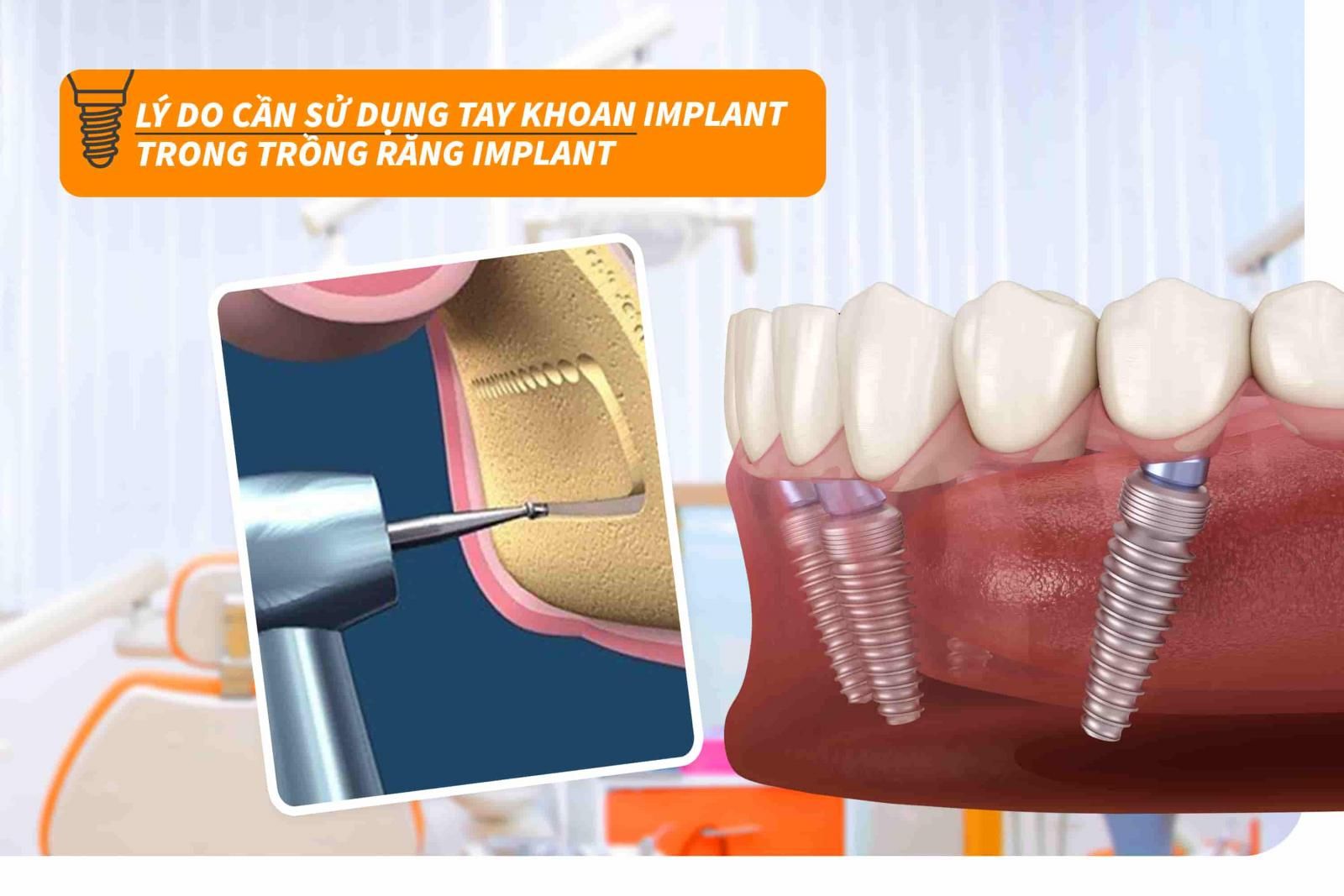 Vì sao cần sử dụng tay khoan Implant trong trồng răng Implant?