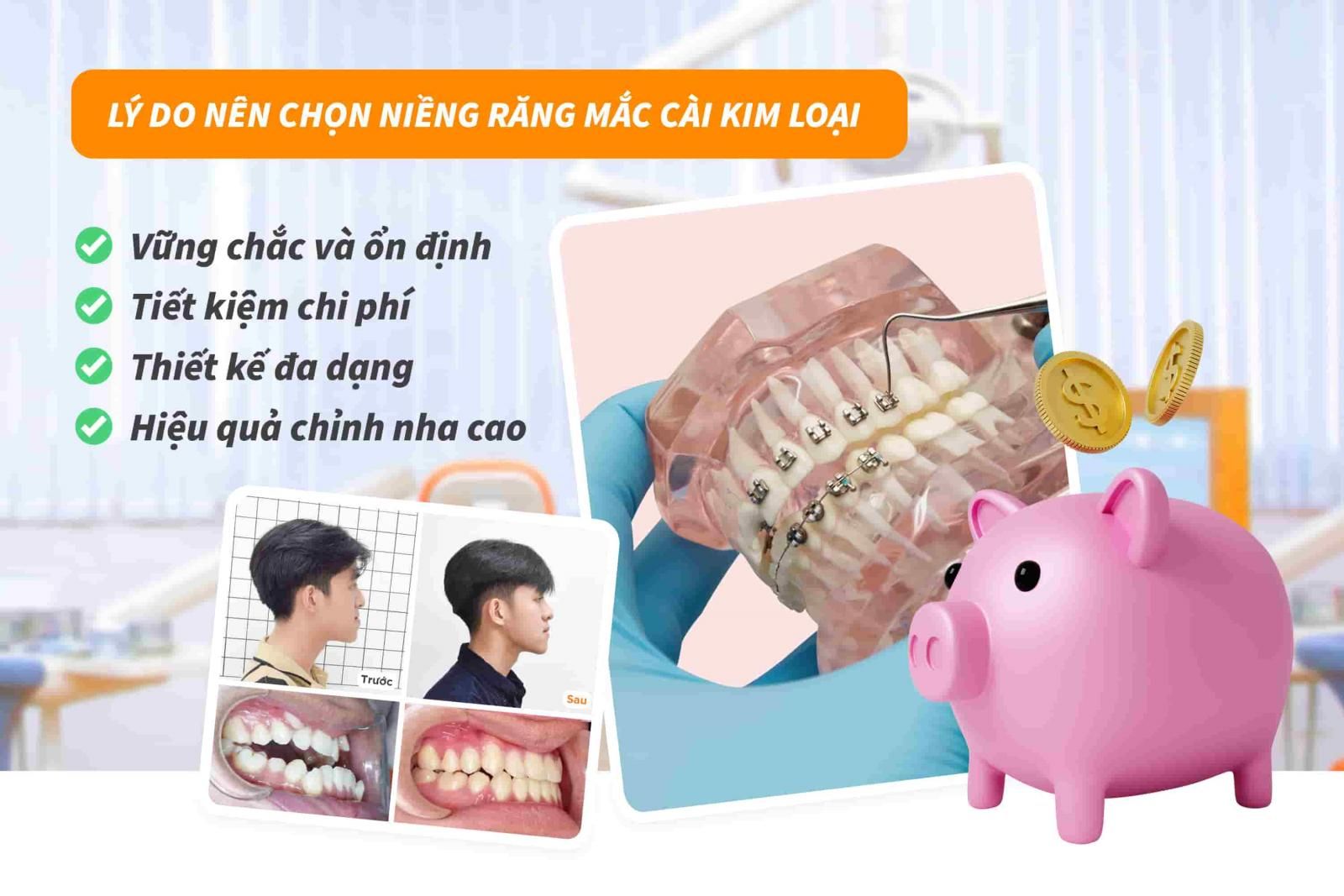 Tại sao nên lựa chọn niềng răng mắc cài kim loại?