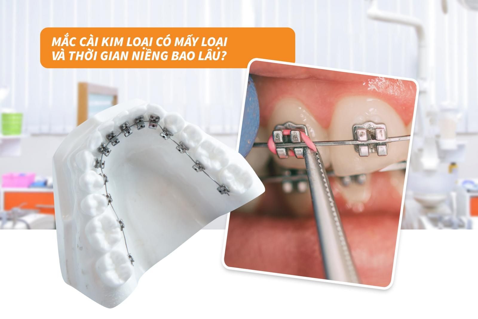 Thời gian niềng mắc cài kim loại bao lâu