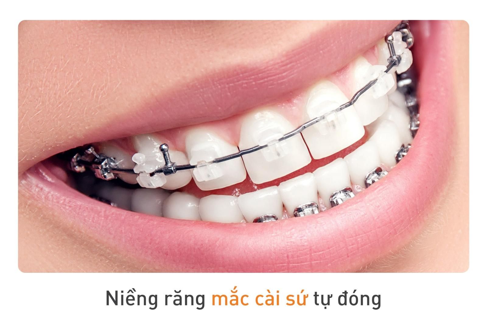 niềng răng mắc cài sứ tự buộc