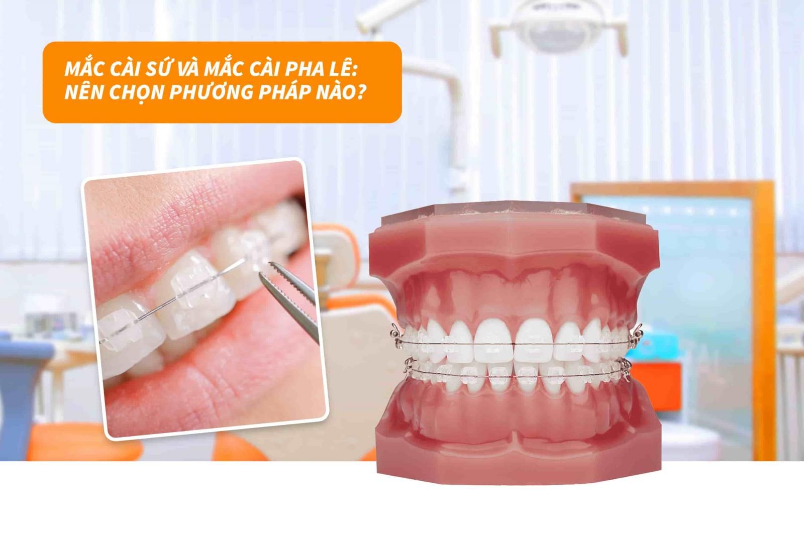 Mắc cài sứ và mắc cài pha lê: Nên chọn phương pháp nào?