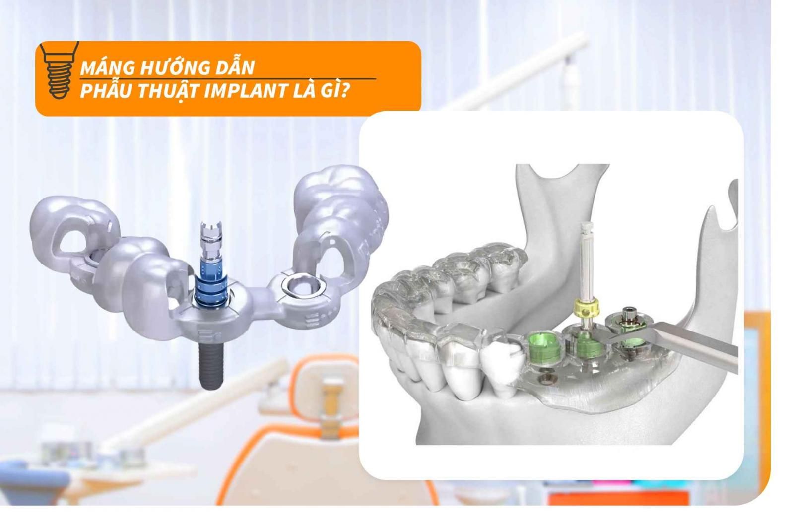 Máng hướng dẫn phẫu thuật Implant là gì? 