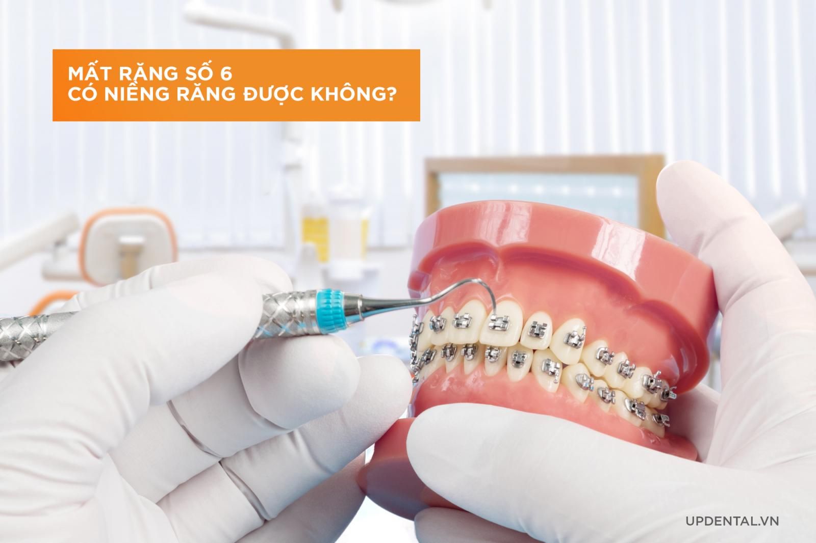 Mất răng số 6 niềng được không