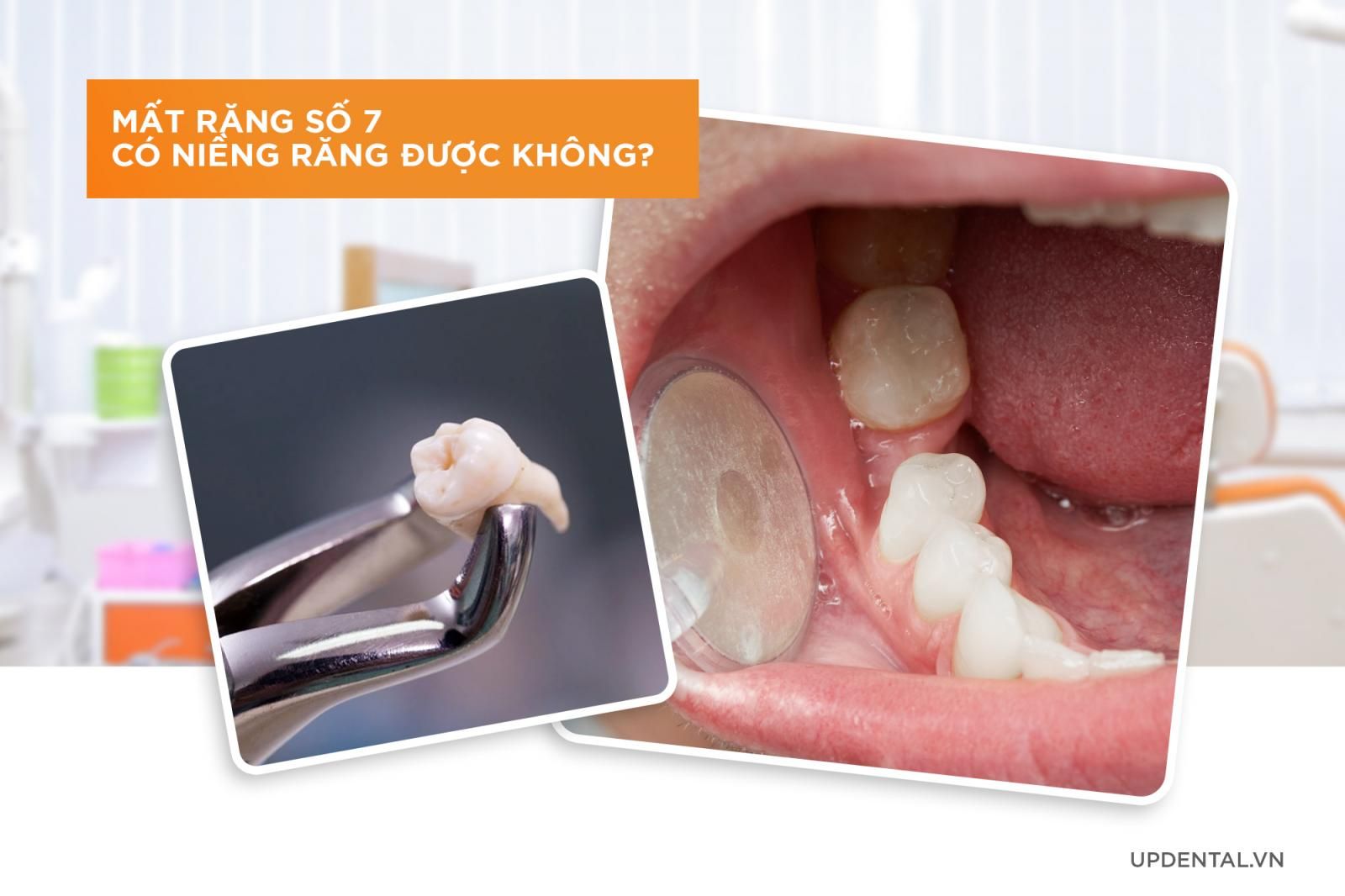 Mất răng số 7 niềng răng được không