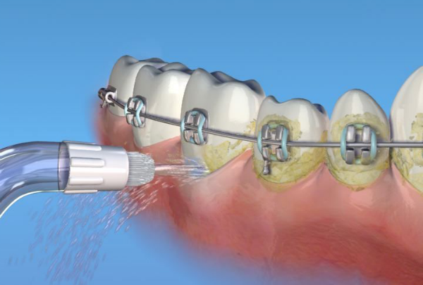 Máy tăm nước rất cần thiết cho các bạn trẻ niềng răng