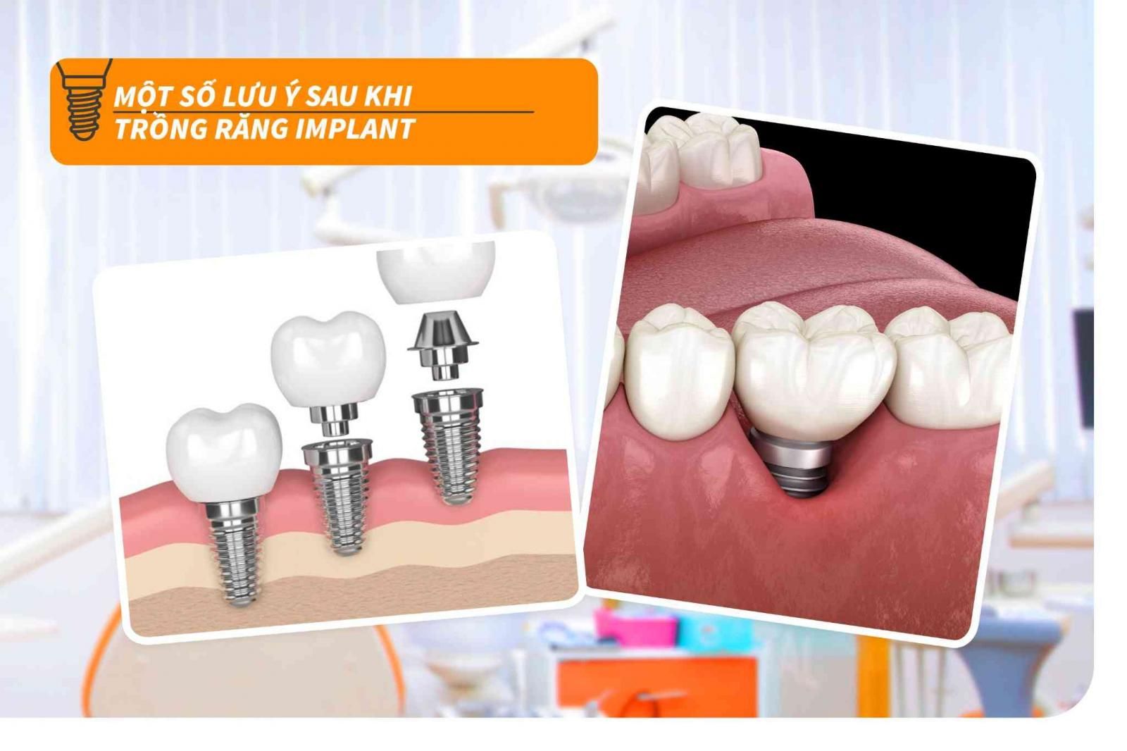 Một số lưu ý sau khi trồng răng Implant