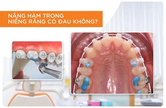 nâng hàm trong niềng răng có đau không