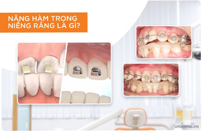 nâng hàm trong niềng răng là gì