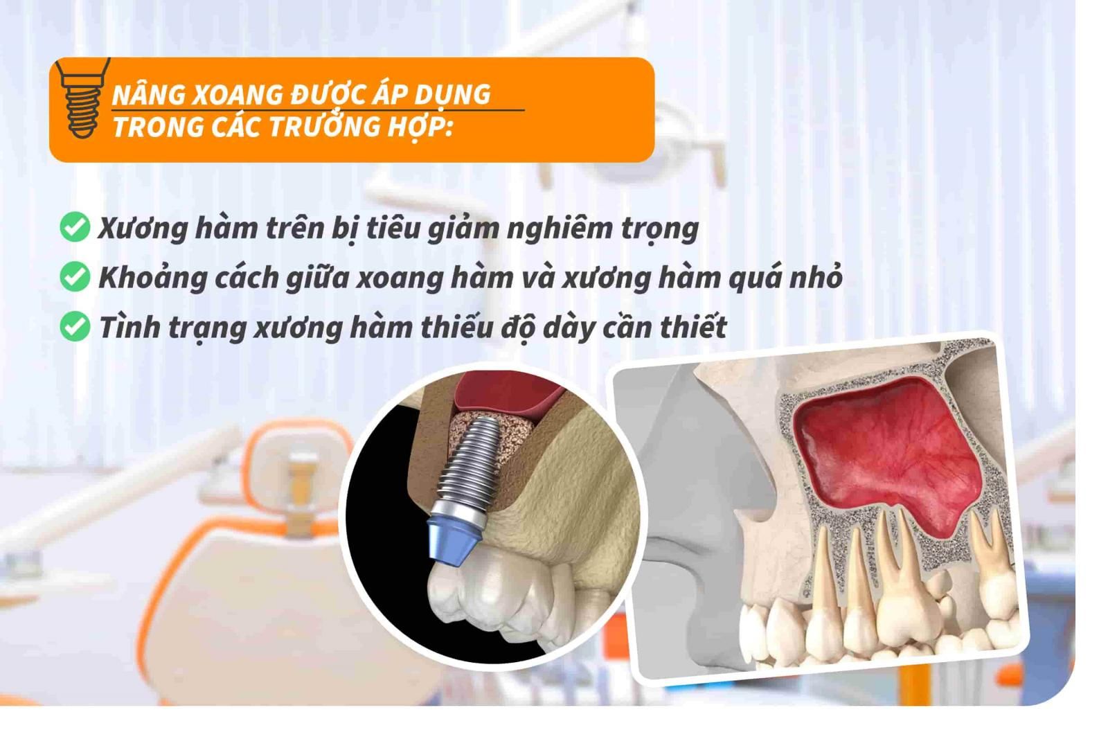 Khi nào cần nâng xoang trong cấy ghép Implant?