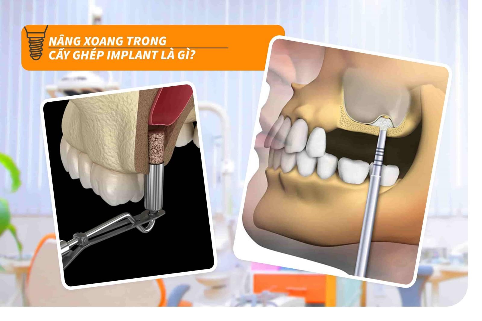 Nâng xoang trong cấy ghép Implant là gì?