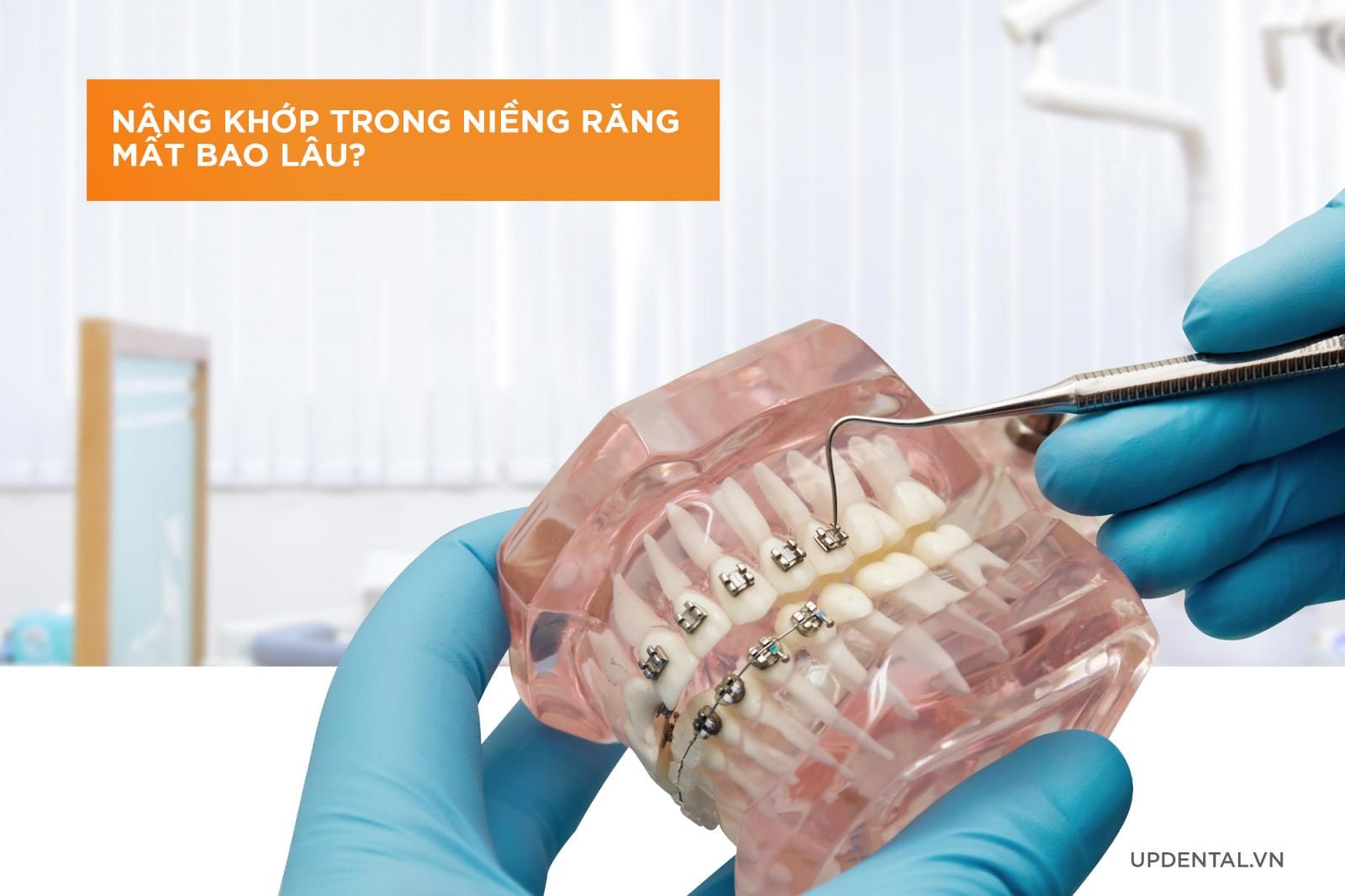 nâng khớp trong niềng răng mất bao lâu