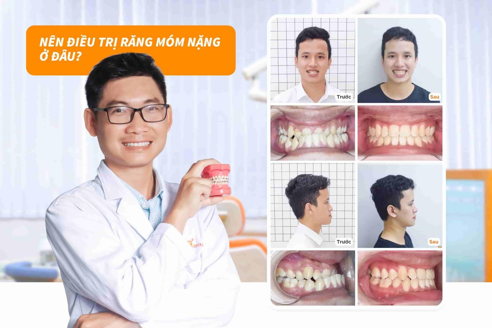 Nên điều trị răng móm nặng ở đâu?