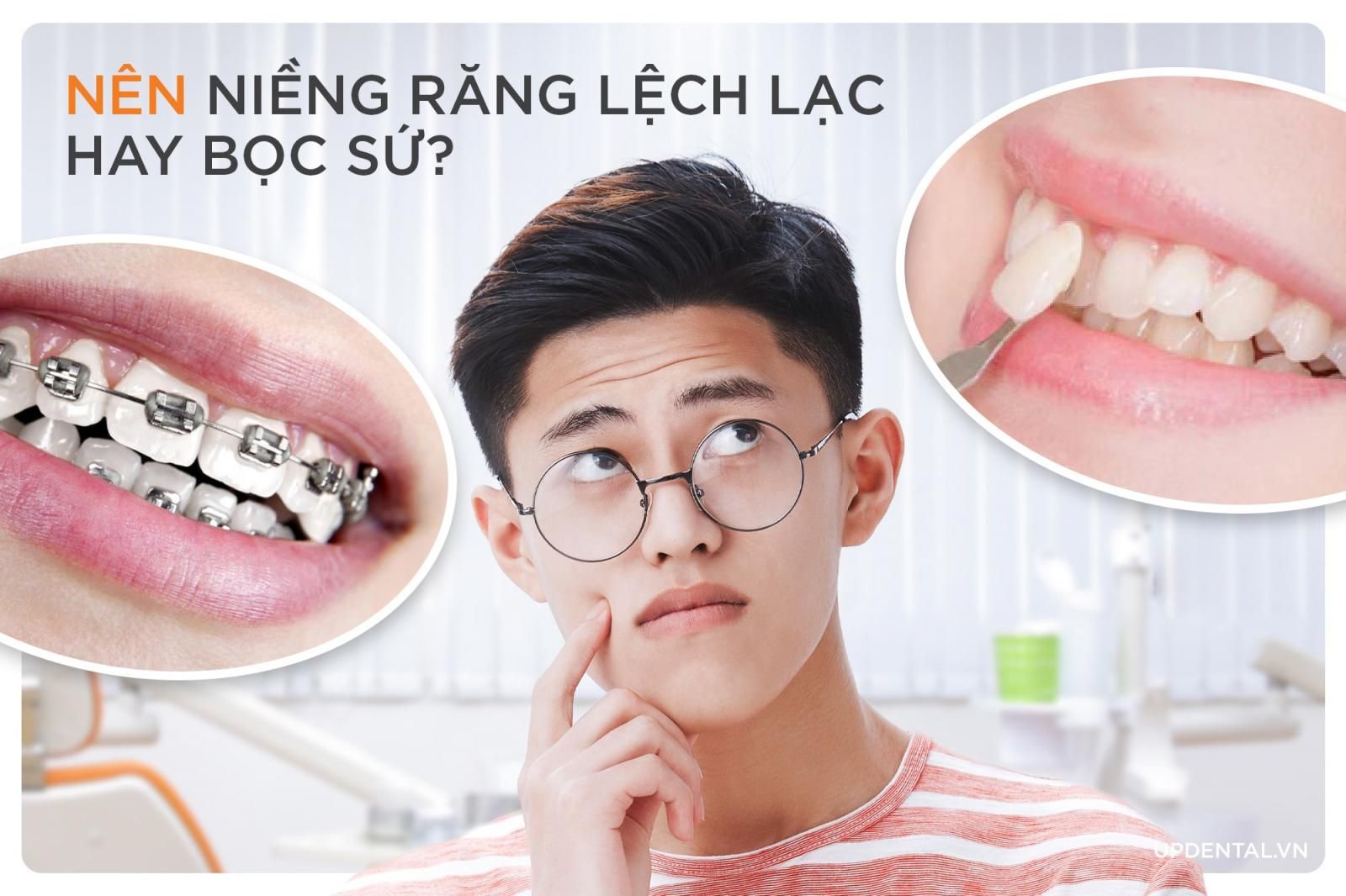 nên niềng răng hay bọc sứ