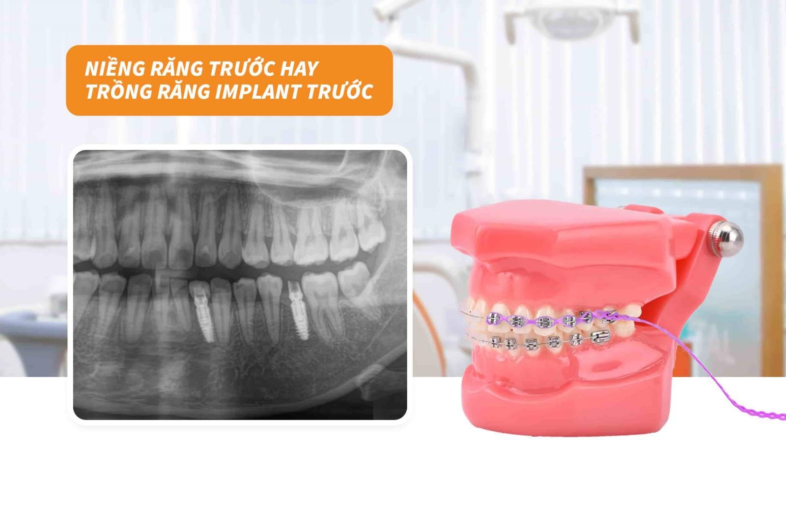 Nên niềng răng trước hay trồng răng Implant trước?