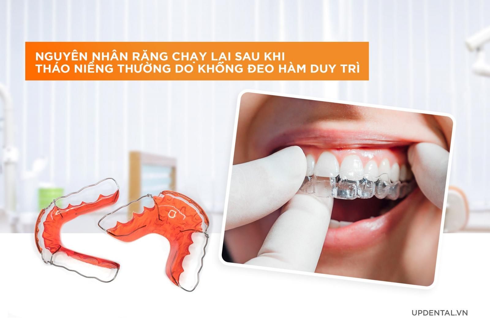 nguyên nhân răng chạy lại sau khi tháo niềng