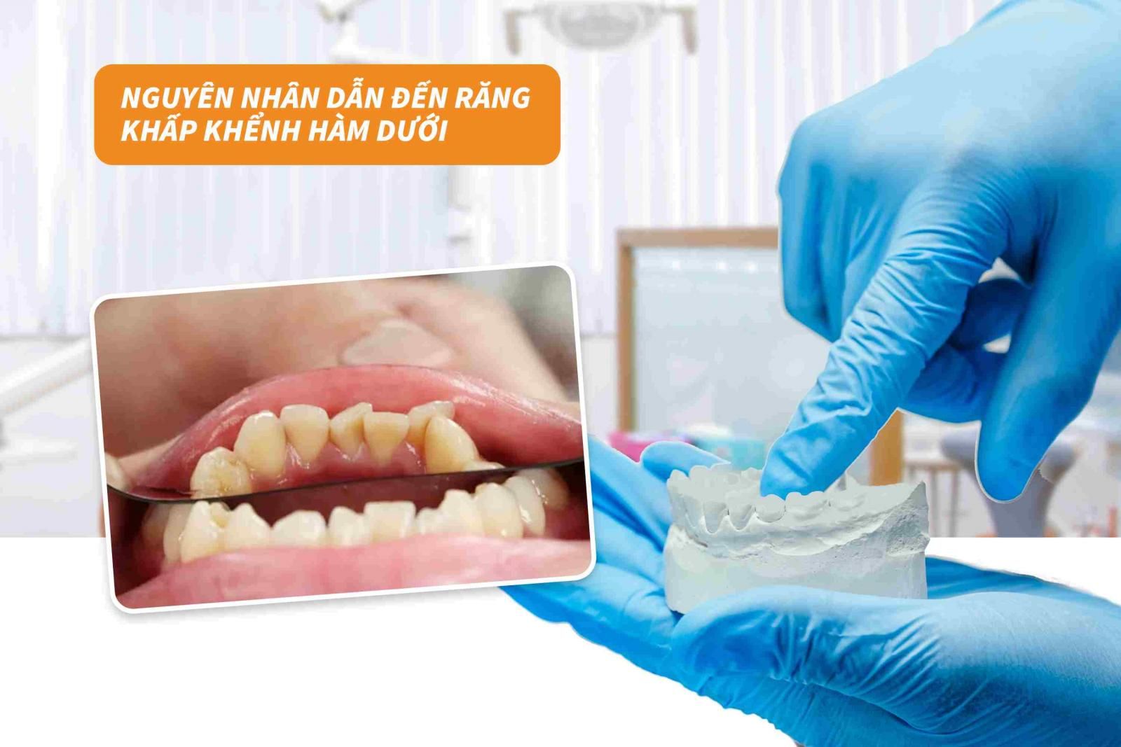 Nguyên nhân dẫn đến răng khấp khểnh hàm dưới 