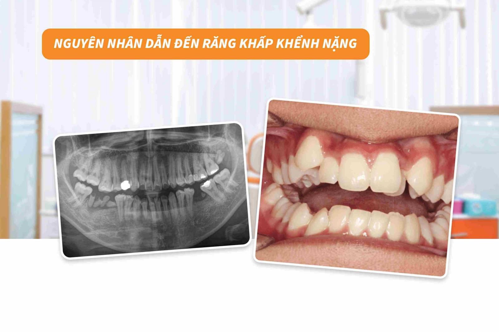 Nguyên nhân dẫn đến răng khấp khểnh nặng