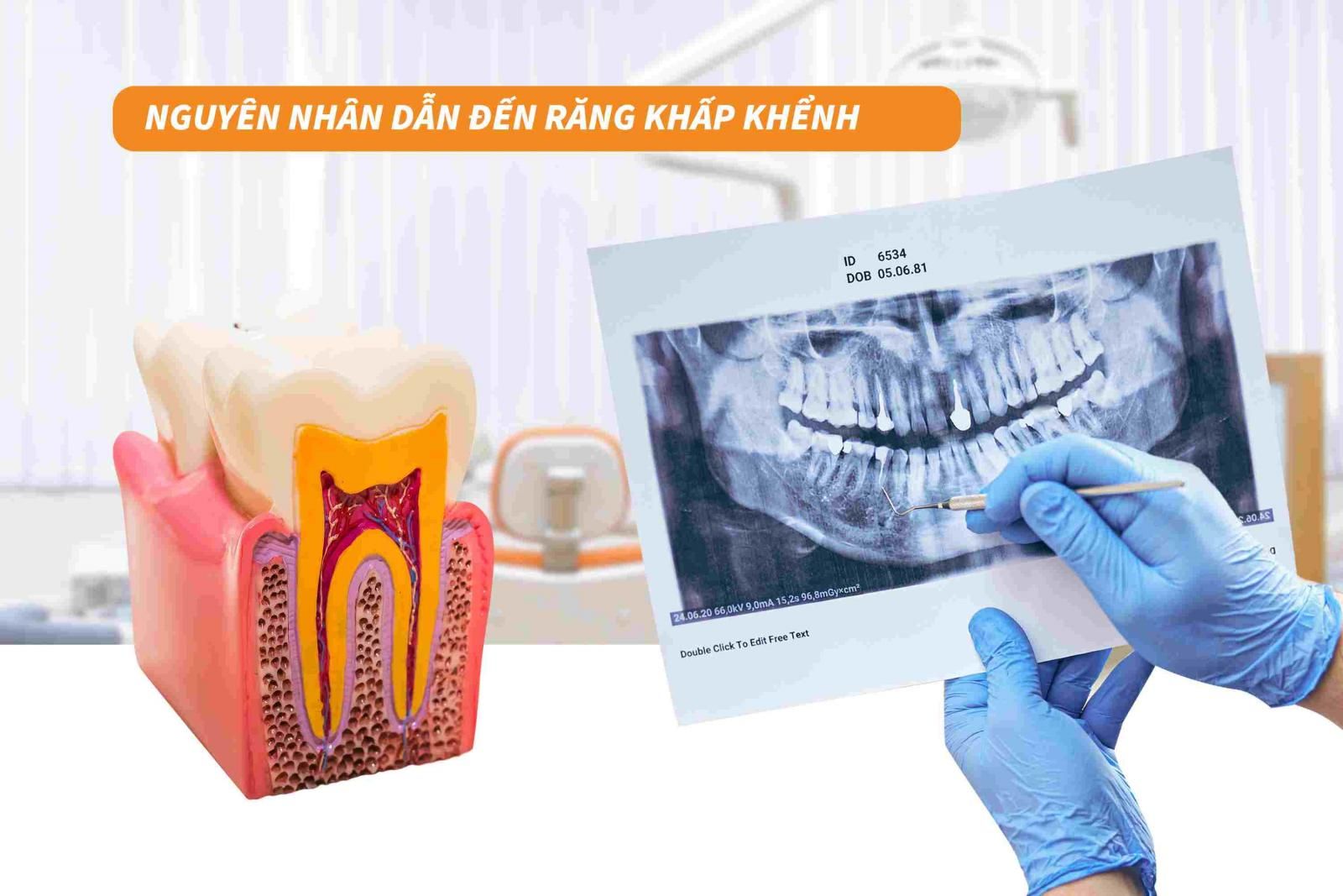 Nguyên nhân dẫn đến răng khấp khểnh