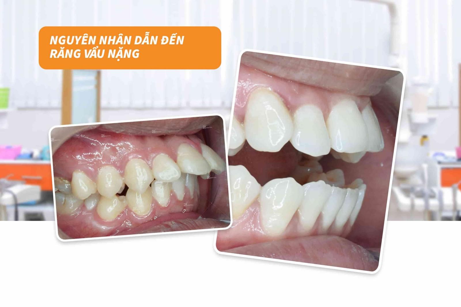 Nguyên nhân dẫn đến tình trạng răng vẩu nặng