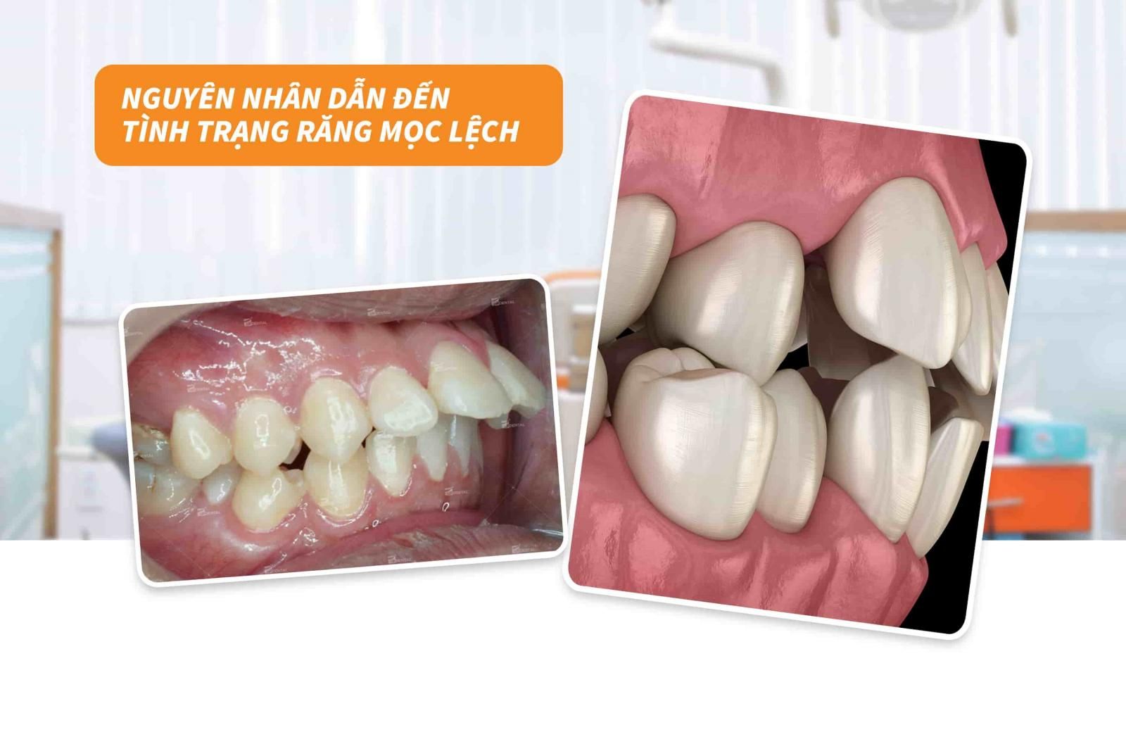 Nguyên nhân dẫn đến tình trạng răng mọc lệch