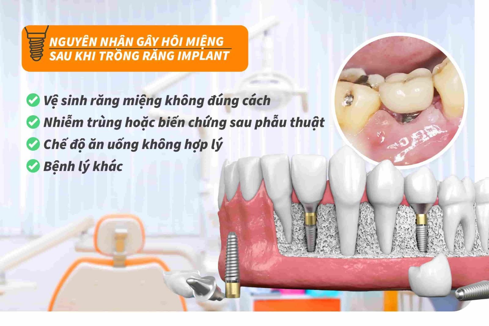 Nguyên nhân gây hôi miệng sau khi trồng răng Implant