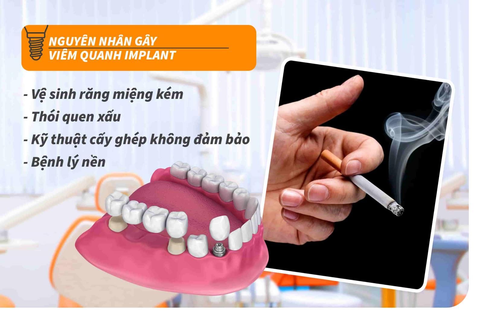 Nguyên nhân gây viêm quanh Implant