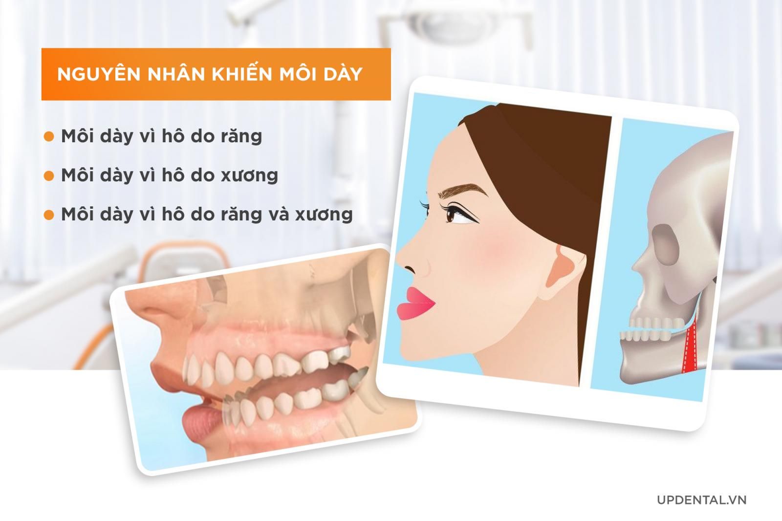 nguyên nhấn khiến môi dầy