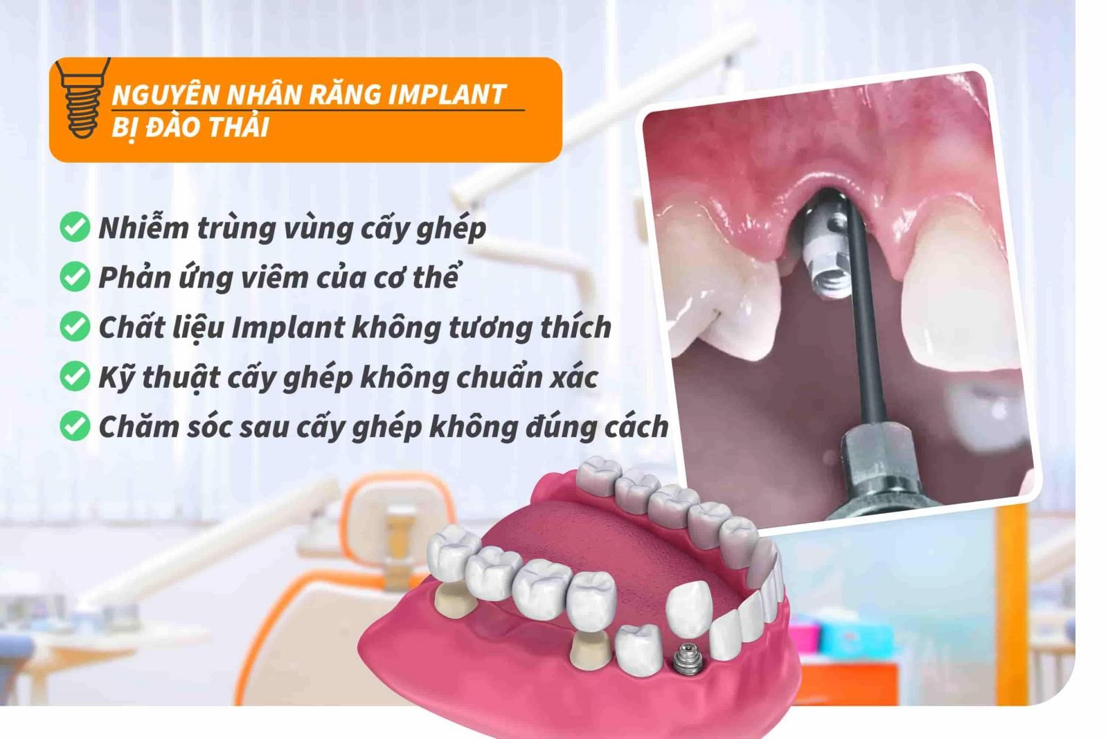 Nguyên nhân răng Implant bị đào thải