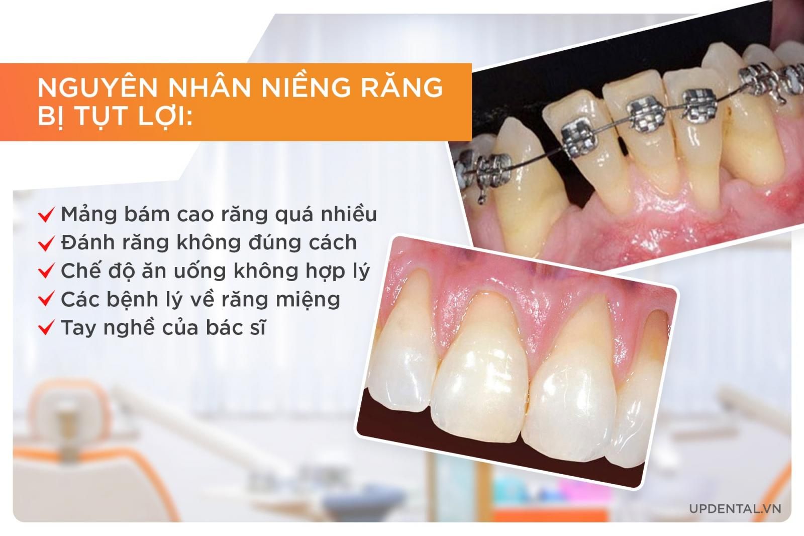 Nguyên nhân niềng răng bị tụt lợi