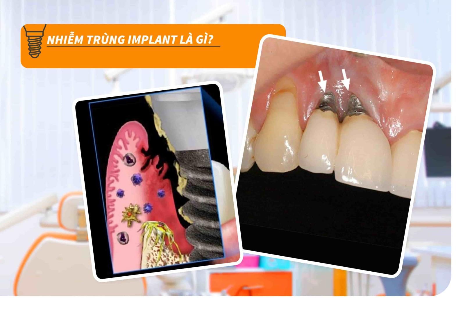 Nhiễm trùng Implant là gì?