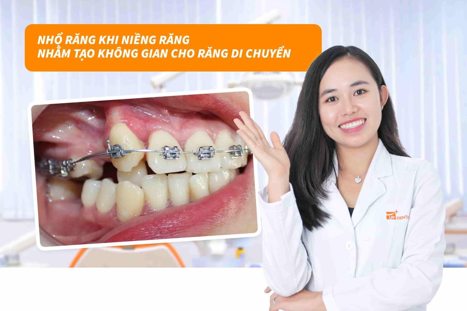 Nhổ răng để tạo không gian cho răng di chuyển