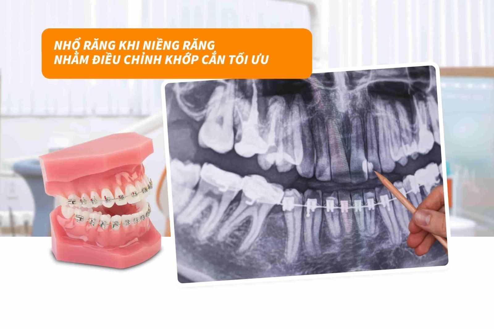 Điều chỉnh khớp cắn