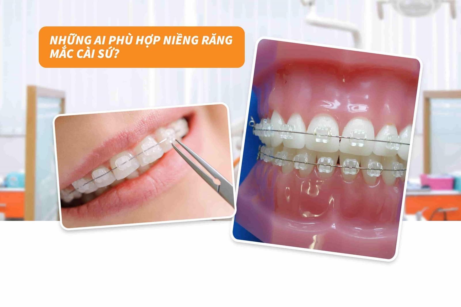 Những ai phù hợp niềng răng mắc cài sứ