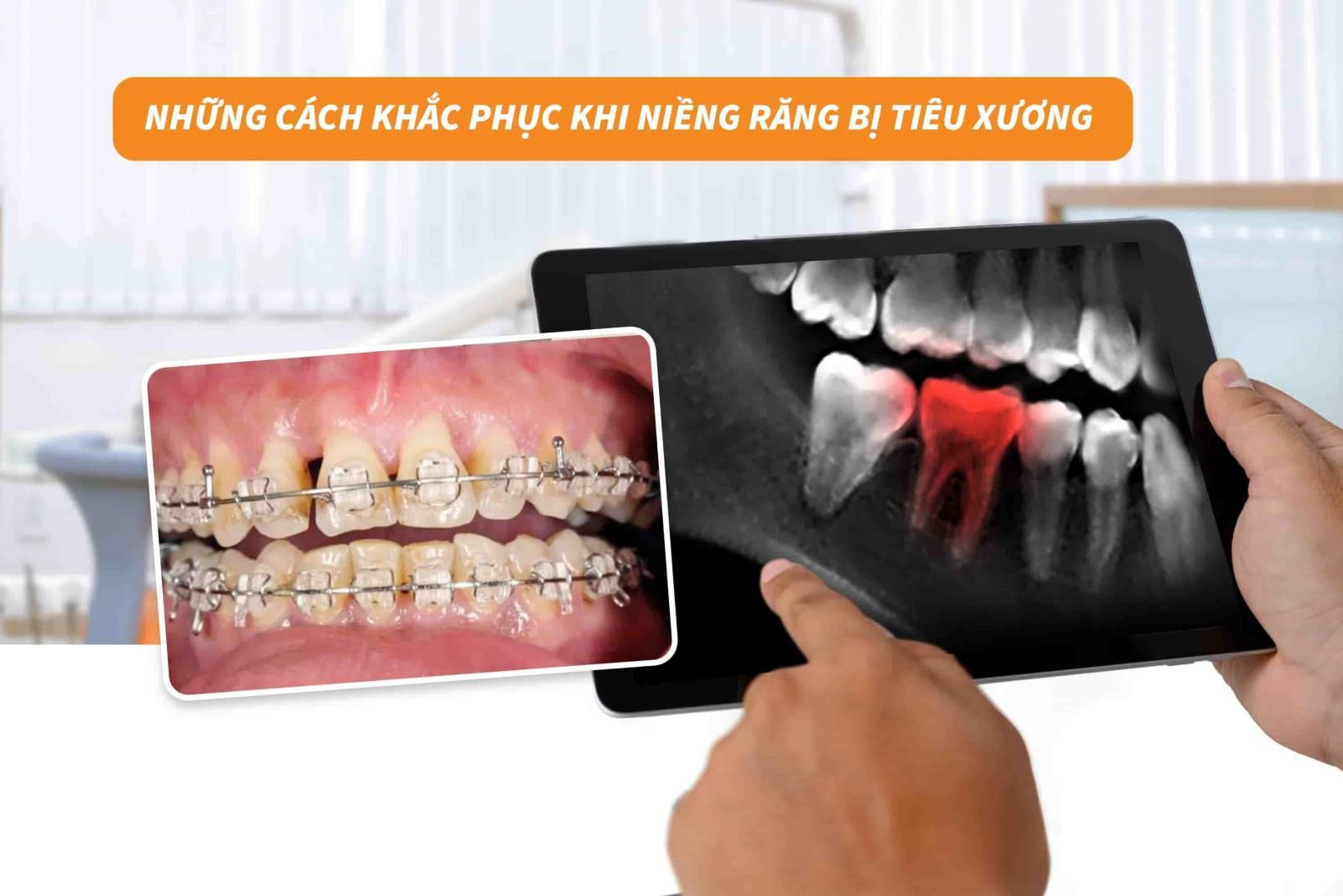 Những cách khắc phục khi niềng răng bị tiêu xương