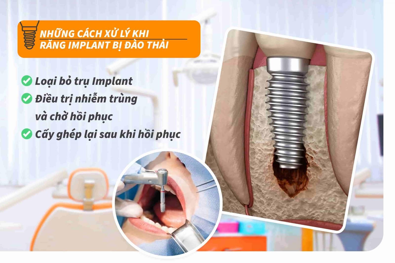 Những cách xử lý khi răng Implant bị đào thải