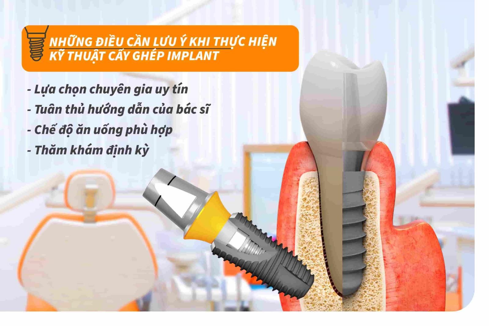 Những điều cần lưu ý khi thực hiện kỹ thuật cấy ghép Implant