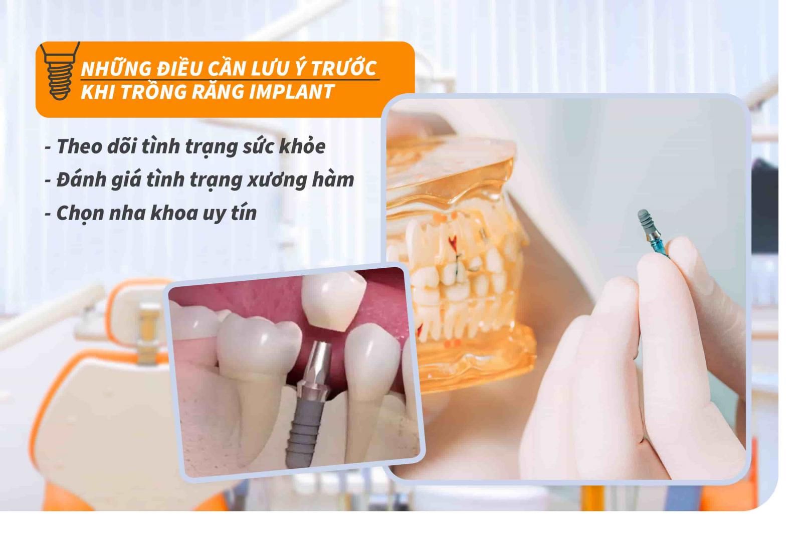 Những điều cần lưu ý trước khi trồng răng Implant