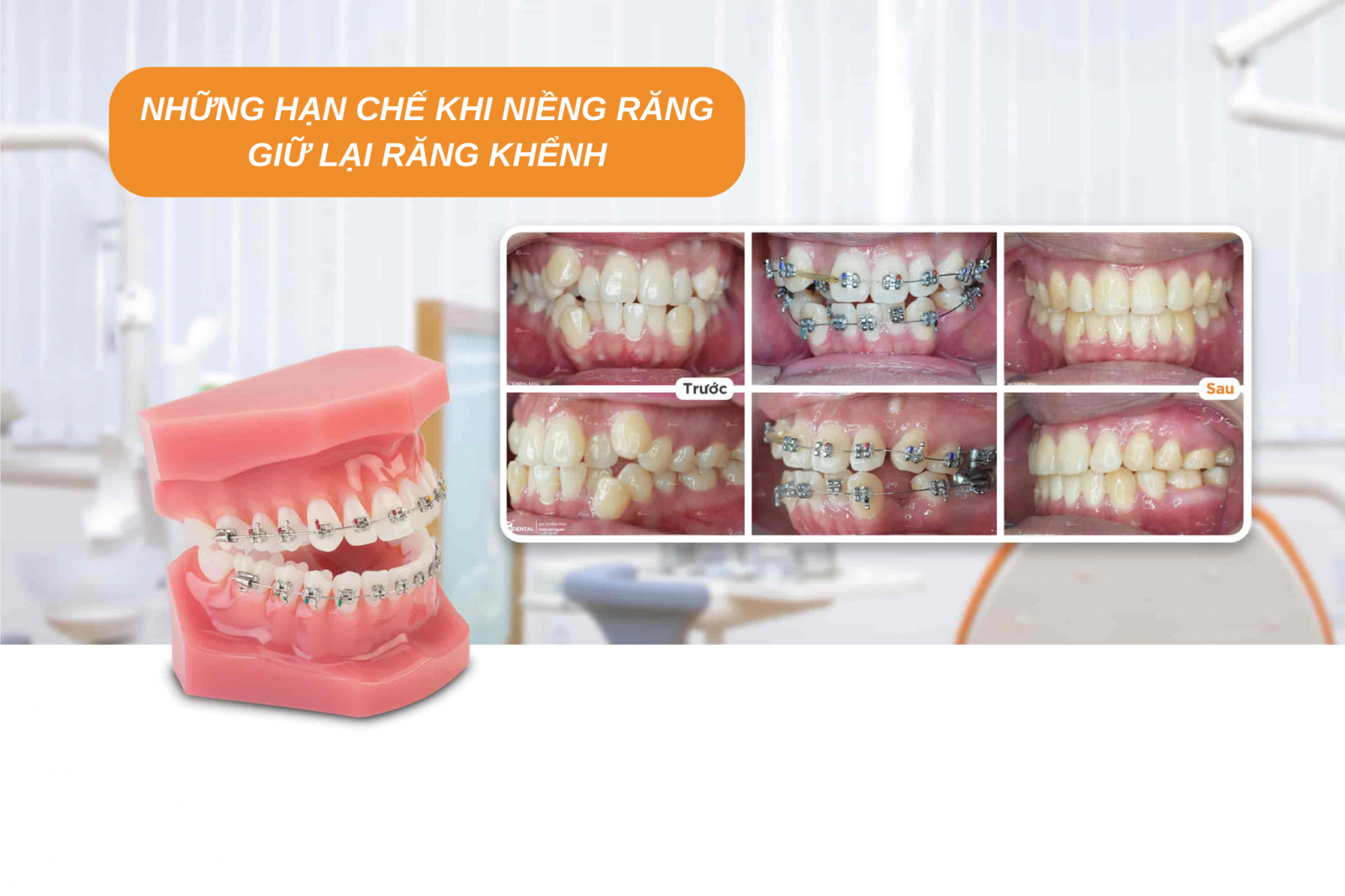 Những hạn chế khi niềng răng giữ lại răng khểnh