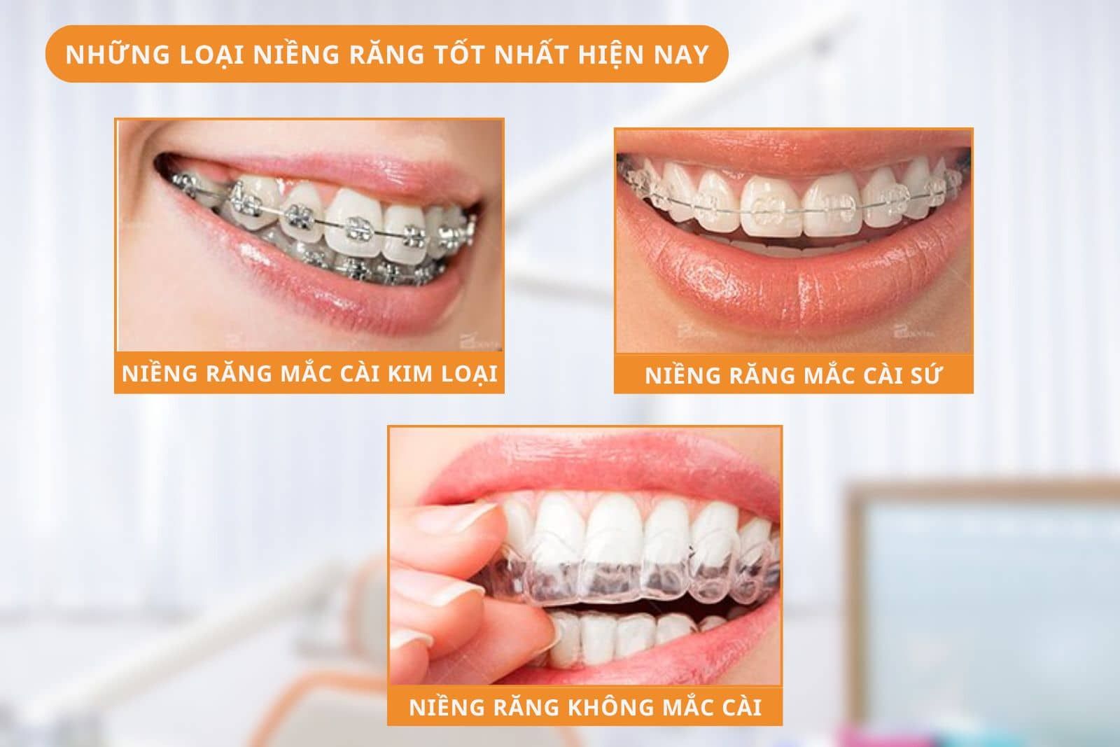 Những loại niềng răng tốt nhất hiện nay