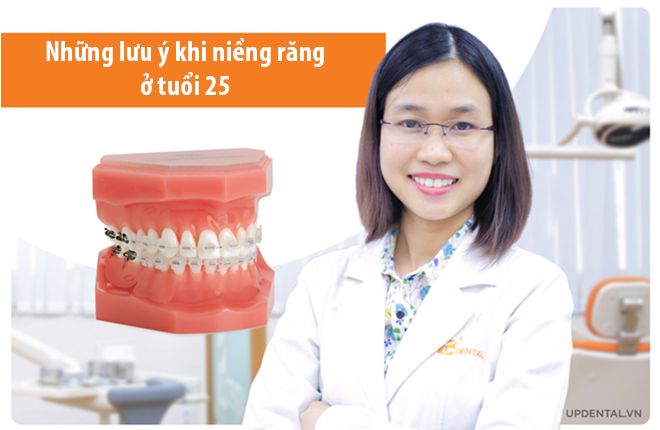 những lưu ý khi niểng răng