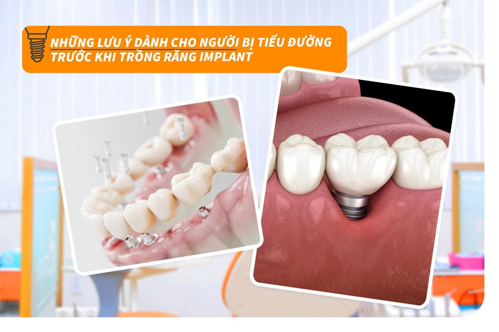 Những lưu ý dành cho người bị tiểu đường trước khi trồng răng Implant