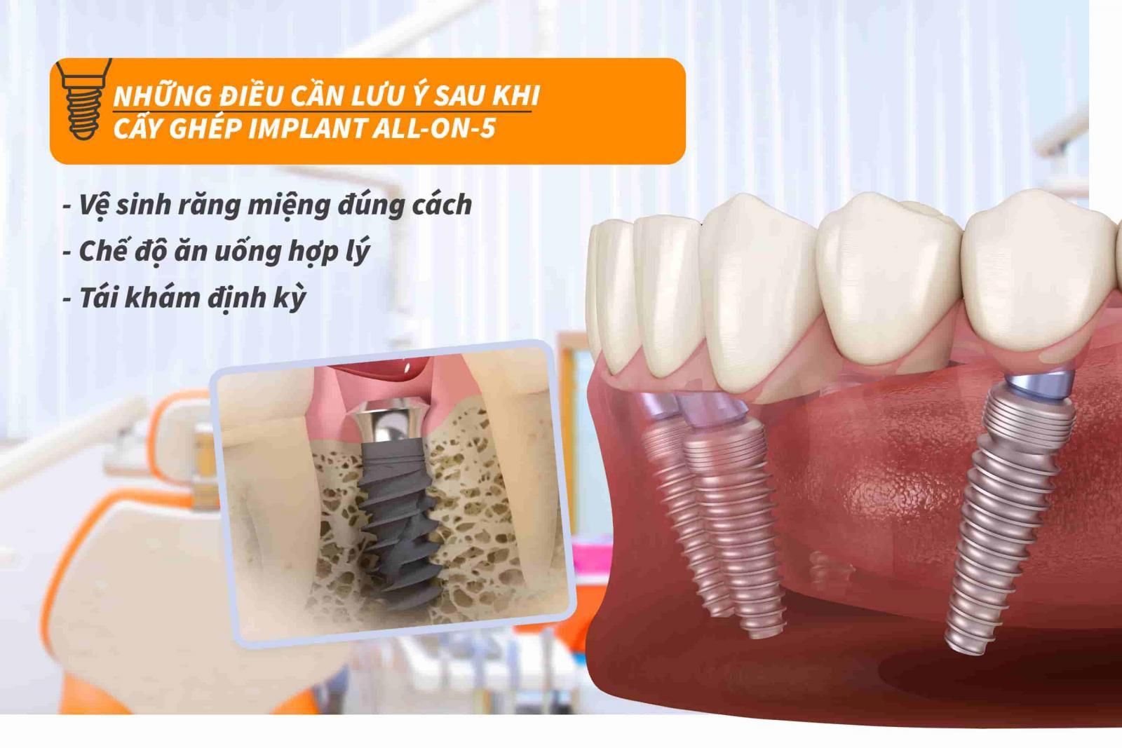 Những điều cần lưu ý sau khi cấy ghép Implant all-on-5