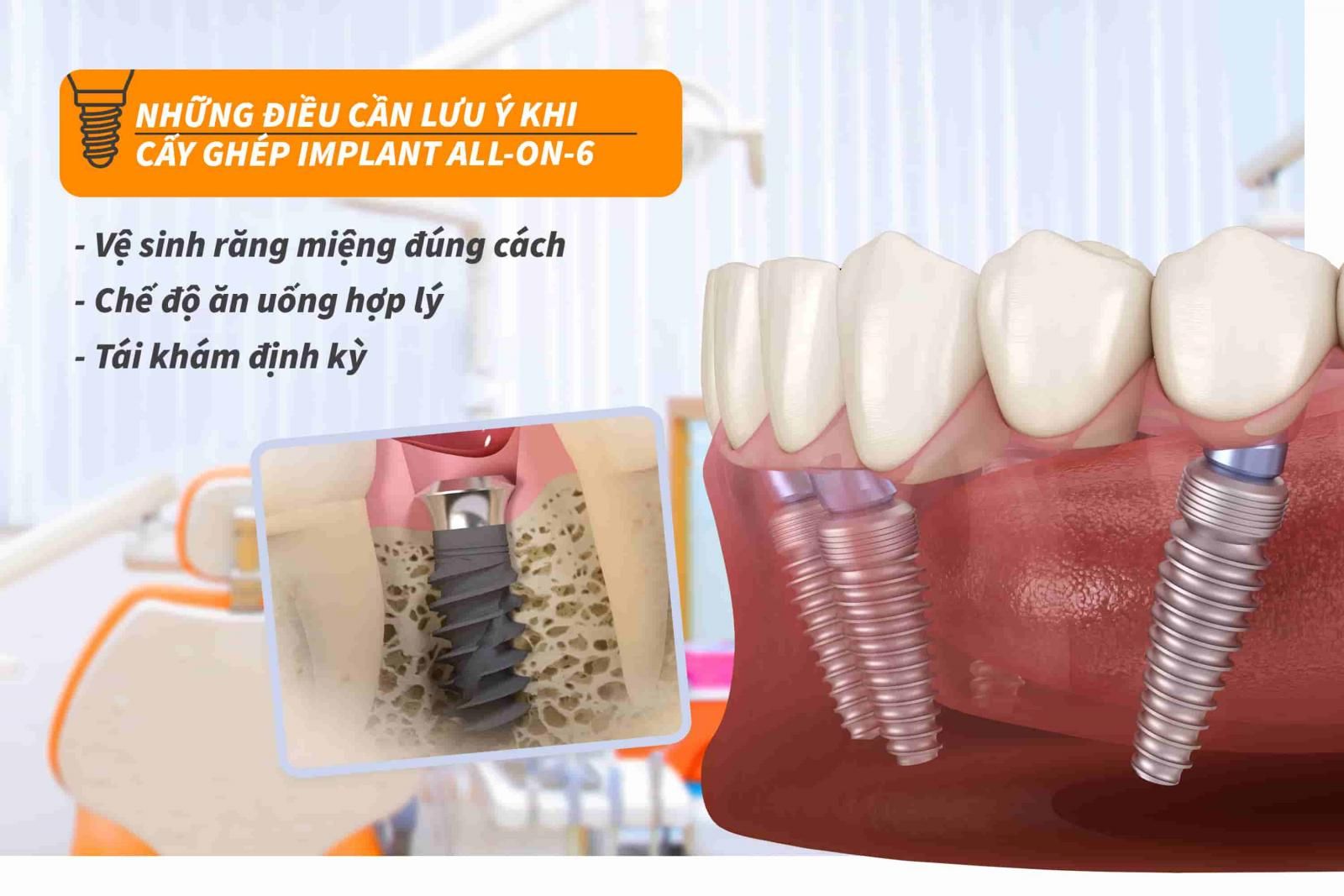 Những điều cần lưu ý khi cấy ghép Implant all-on-6