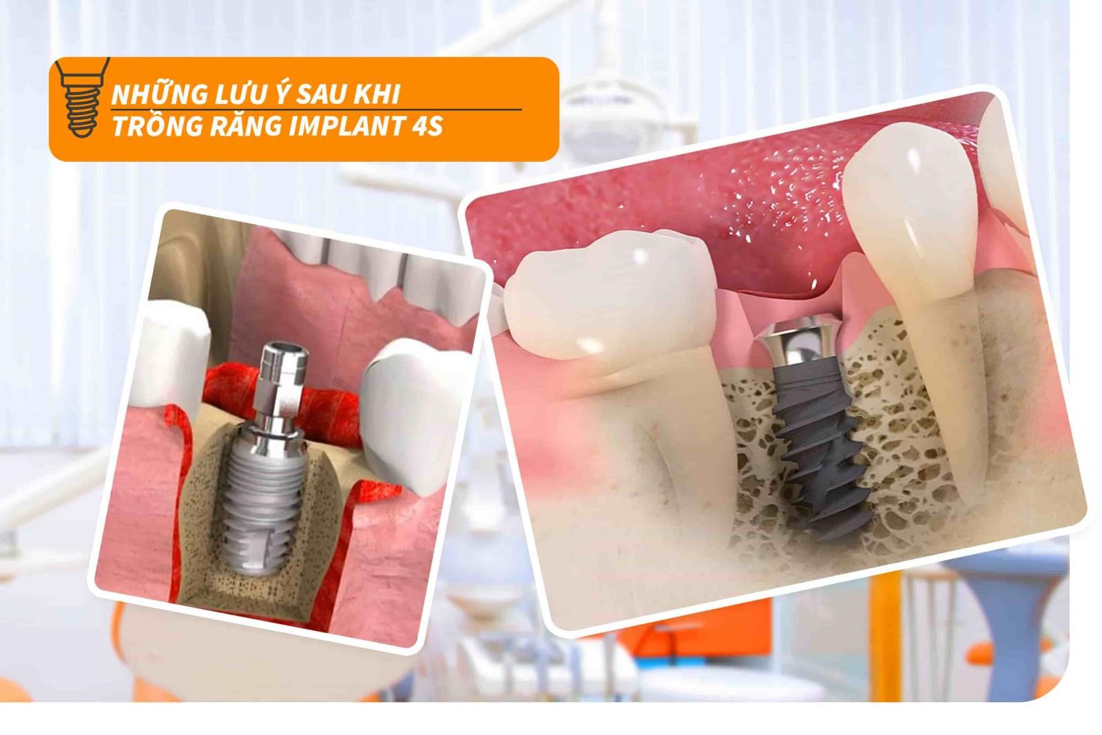 Những lưu ý sau khi trồng răng Implant 4S