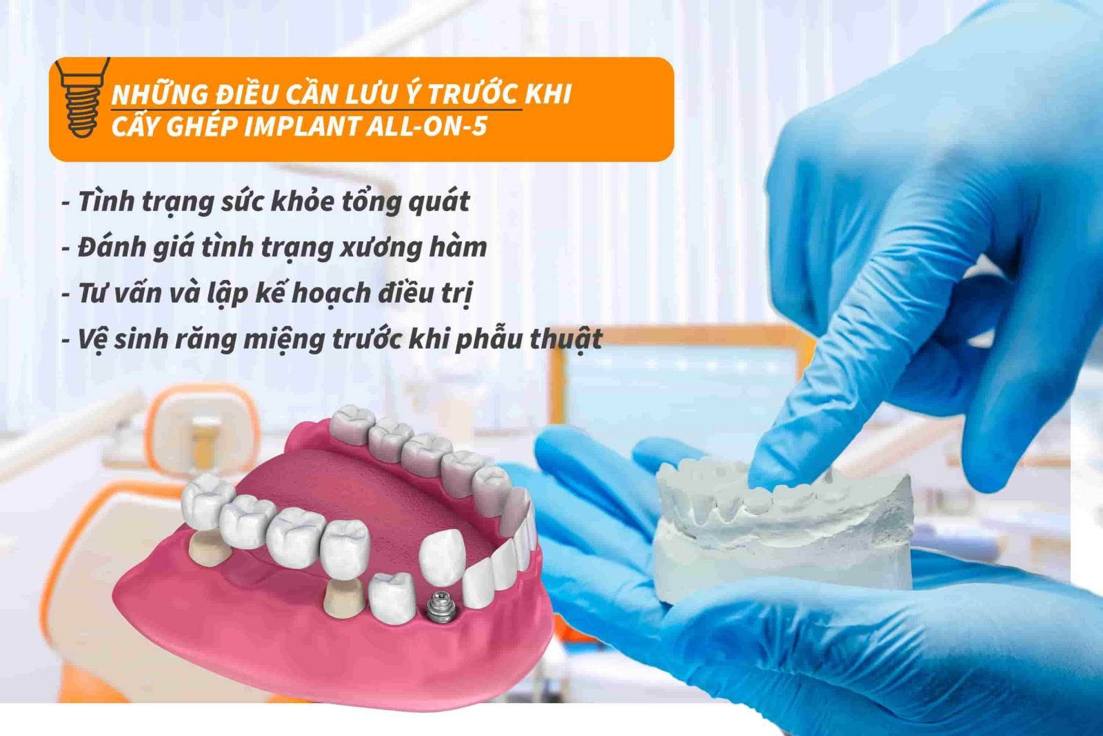 Những điều cần lưu ý trước khi cấy ghép Implant all-on-5